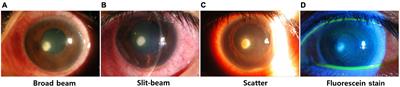 Deep learning-based classification system of bacterial keratitis and fungal keratitis using anterior segment images